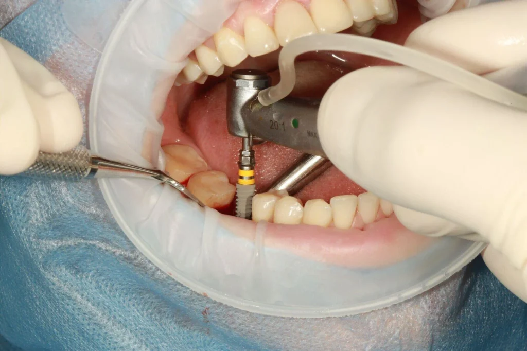 dental restoration