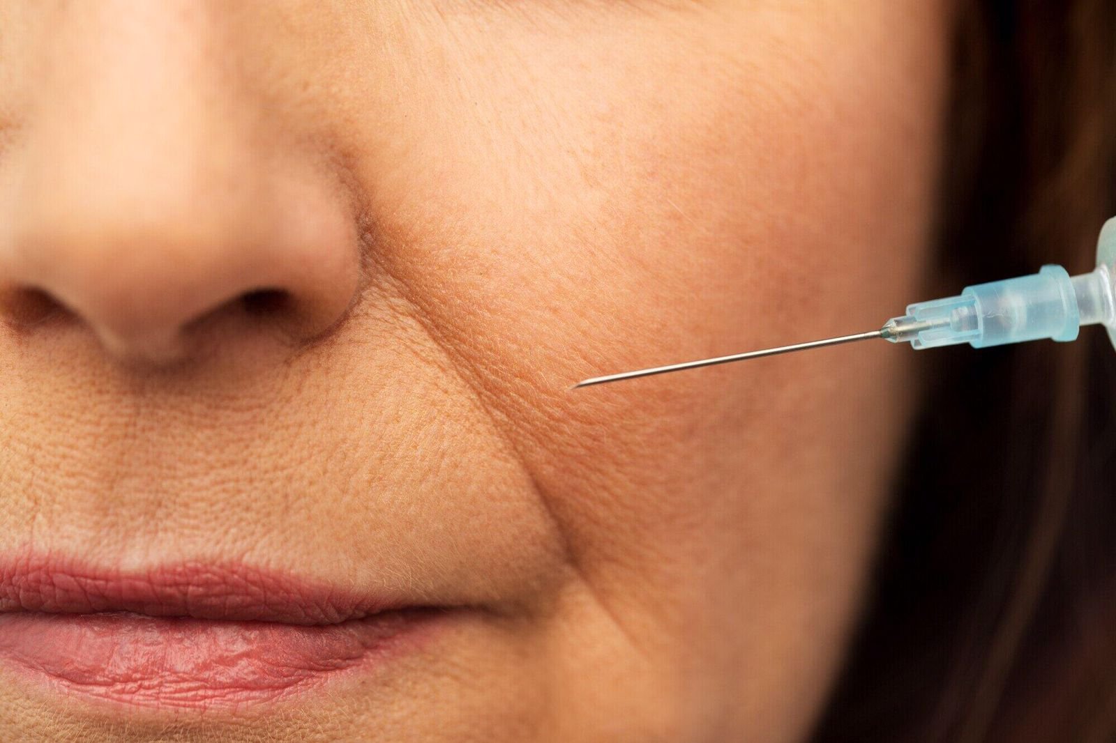 botox on smile lines