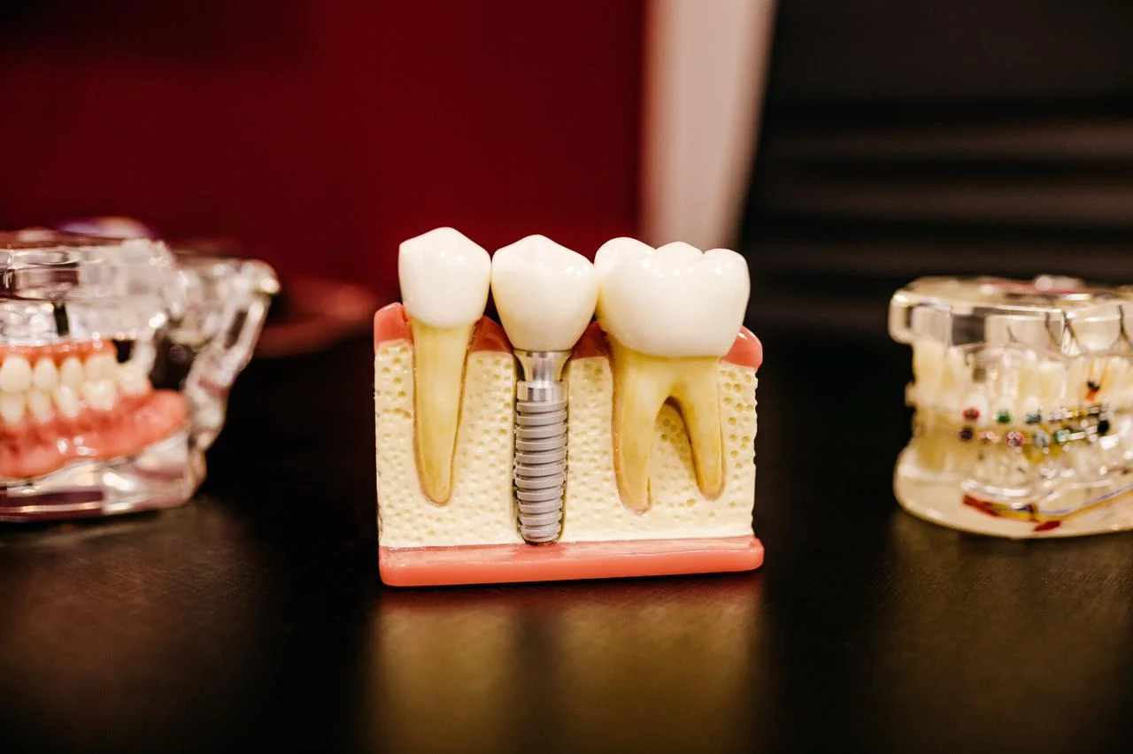 dental implants for back teeth